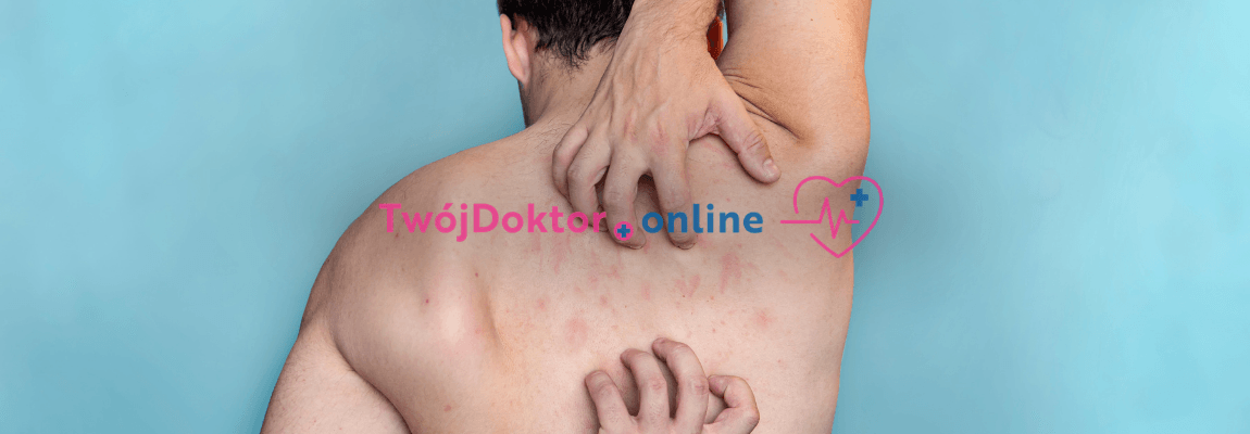 Mężczyzna drapiący się po plecach z widocznymi zmianami skórnymi. TwójDoktor.online — leki na świerzb dostępne po e-recepcie od lekarza.